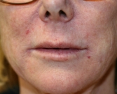 Feel Beautiful - Smile Lines (Nasal-Labial Folds) Filler - After Photo